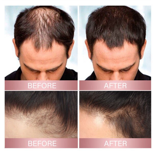 1/2/3/4/5PCS Zephta H-Regrow 2.0 Zephta Hair Regrowth Prorevita Rice Nutri Spray - Image 7